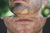 Terapias de Barbas